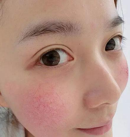 什么是敏感性皮肤